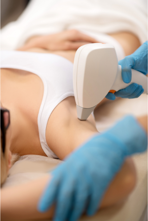 Depilacion laser ipl