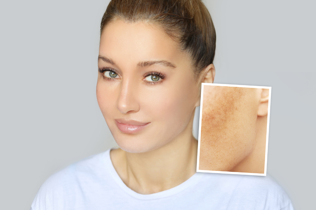 Cómo tratar las manchas en la piel con la alta cosmética