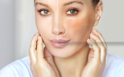 Cómo tratar las manchas en la piel con la alta cosmética