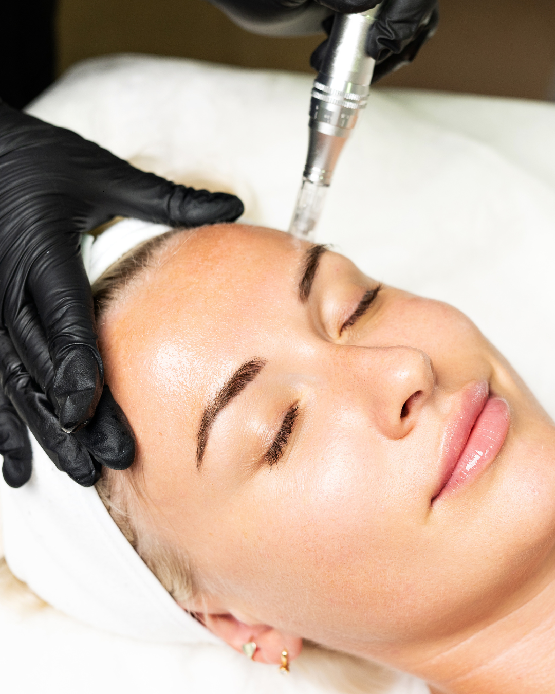 plasma pen en Alicante